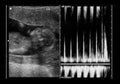 Ultrasound fetus