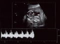 Ultrasound of fetus Royalty Free Stock Photo