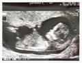 Ultrasound fetus at 12 weeks. Royalty Free Stock Photo