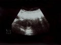 Ultrasound film of the child to be born