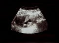 Ultrasound film of the child to be born