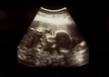 Ultrasound film of the child to be born