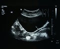 Ultrasound film of a woman kidney abnormal