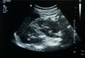 Ultrasound film of a woman kidney