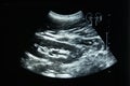 Ultrasound film of a woman left kidney