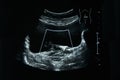 Ultrasound film of a woman left ureter abnormal