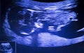 Ultrasound foetus pregnancy scan