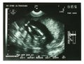 Ultrasound image