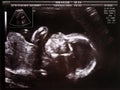 Ultrasound image