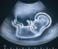 Ultrasound image of baby in mother's womb