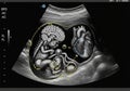 An ultrasound image featuring AI-generated enhancements of a Royalty Free Stock Photo