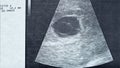 Ultrasound image of the gestational sac and the vitelline bladder with the embryo, of a pregnancy stopped in evolution