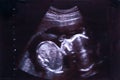 Ultrasound image of a human embryo between 15 and 20 weeks