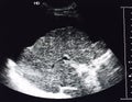 Ultrasound image of liver cirrhosis Royalty Free Stock Photo