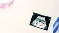 Ultrasound photo pregnancy baby. Blue, pink ribbon with ultrasound pregnancy picture on white background. Concept Royalty Free Stock Photo