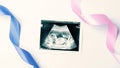 Ultrasound photo pregnancy baby. Blue, pink ribbon with ultrasound pregnancy picture on white background. Concept Royalty Free Stock Photo