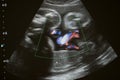 Ultrasound photo of unborn baby in mother`s womb, closeup view Royalty Free Stock Photo