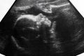Ultrasound photo of unborn baby in mother`s womb Royalty Free Stock Photo