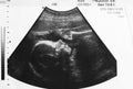 Ultrasound photo of unborn baby in mother`s womb Royalty Free Stock Photo