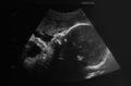 Ultrasound photo of unborn baby in mother`s womb Royalty Free Stock Photo