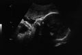 Ultrasound photo of unborn baby in mother`s womb Royalty Free Stock Photo