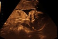 Ultrasound picture of a child