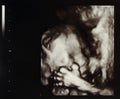 Ultrasound pregnancy Royalty Free Stock Photo