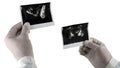 Ultrasound of the prostate isolated on white background, picture of the male prostate at the doctor`s hands.