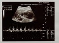 Ultrasound scan of future baby Royalty Free Stock Photo