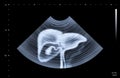 Ultrasound scan of humal liver.