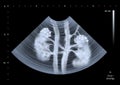 Ultrasound scan of human kidneys Royalty Free Stock Photo