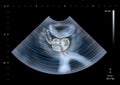 Ultrasound scan of human Prostate Royalty Free Stock Photo
