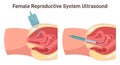 Ultrasound scanning. Female reproductive system research. Gynecological disease