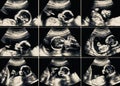 Ultrasound scans collage during pregnancy at the end of third mo