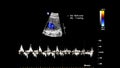 Ultrasound screen with fetal echocardiography