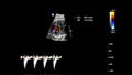 Ultrasound screen with fetal echocardiography