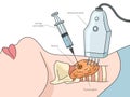 Ultrasound thyroid puncture diagram medical