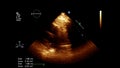 Ultrasound transesophageal examination of the heart.