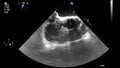 Ultrasound transesophageal examination of the heart.