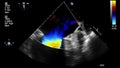 Ultrasound transesophageal examination of the heart.