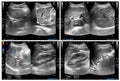 Ultrasound upper abdomen