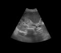 Ultrasound upper abdomen showing anatomical of liver .