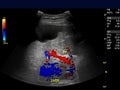 Ultrasound upper abdomen showing flow in common bile duct .