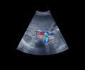 Ultrasound upper abdomen showing flow in common bile duct after use color Doppler. clipping path