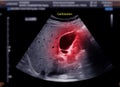 Ultrasound upper abdomen showing gallbladder for diagnosis gallbladder stone