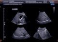 Ultrasound upper abdomen showing gallbladder for diagnosis gallbladder stone