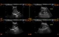 Ultrasound upper abdomen showing Liver, gall bladder and kidney for screening abdominal disease