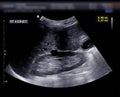 Ultrasound of urinary bladder or KUB.
