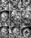 Ultrasound of a young fetus inside the womb. Collection of nine