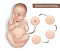 Umbilical cord care in newborns. Newborn umbilical cord stump falling off cycle. Dried stump of an umbilical cord of a